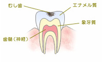 C1：エナメル質の虫歯