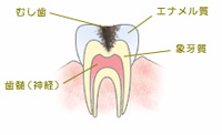 C2：象牙質の虫歯