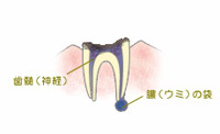 C4：歯根まで進行した虫歯